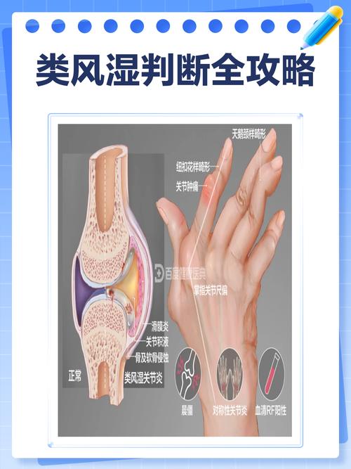 风湿类风湿怎样查得出