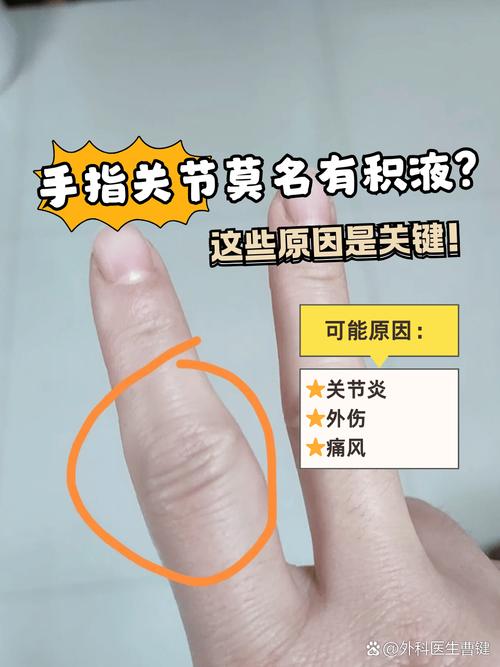 积水是风湿还是类风湿