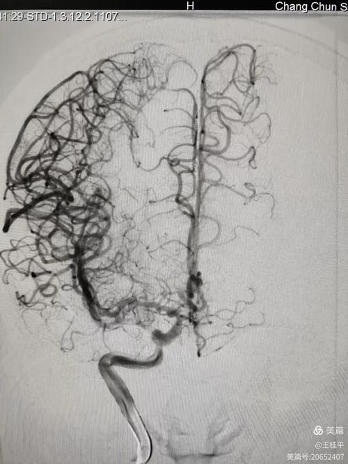 脑部tcd检查 脑梗