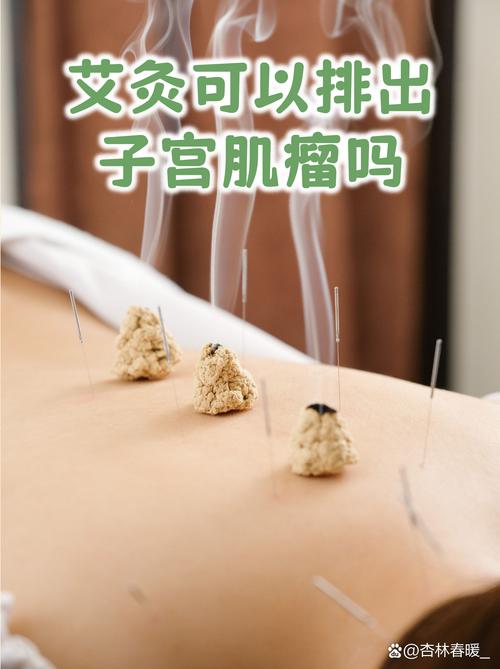 子宫肌瘤艾灸那些穴位