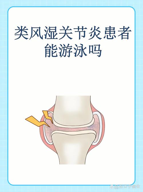 风湿类风湿可以游泳吗