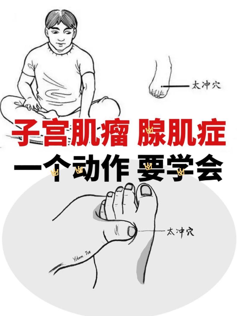 子宫肌瘤按摩那些穴位