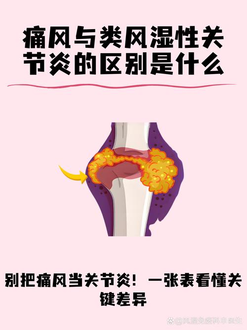 痛风类风湿风湿的区别