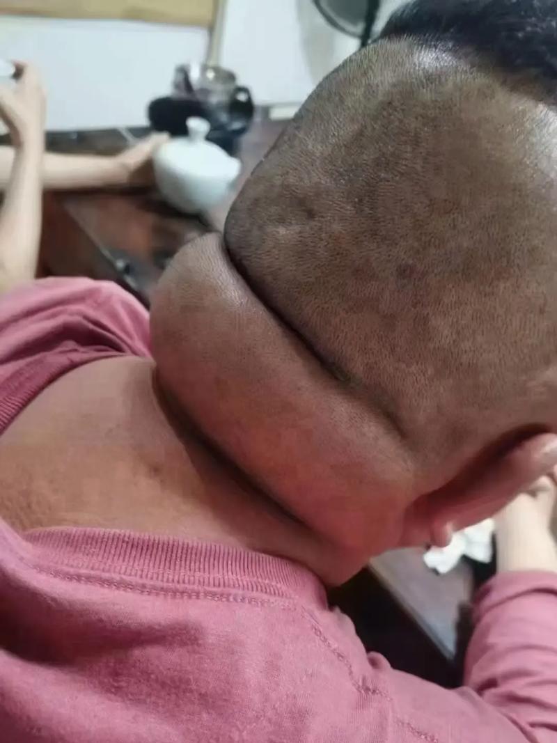 脑梗 失明 恢复案例