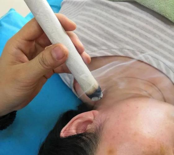 艾灸哪些穴位治疗面瘫