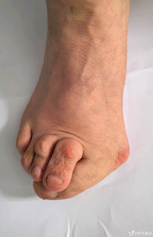 哈尔滨侯氏风湿类风湿