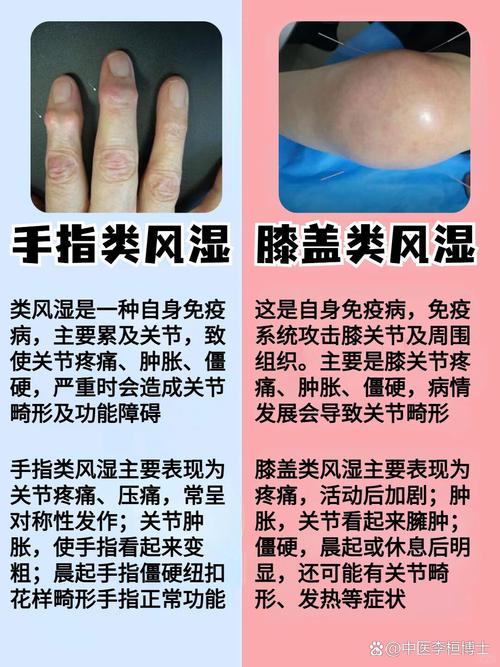 风湿热 类风湿 区别
