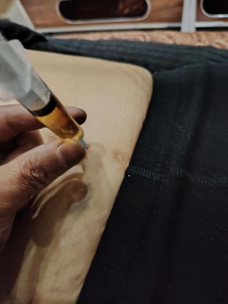 穴位注射治疗支气管炎