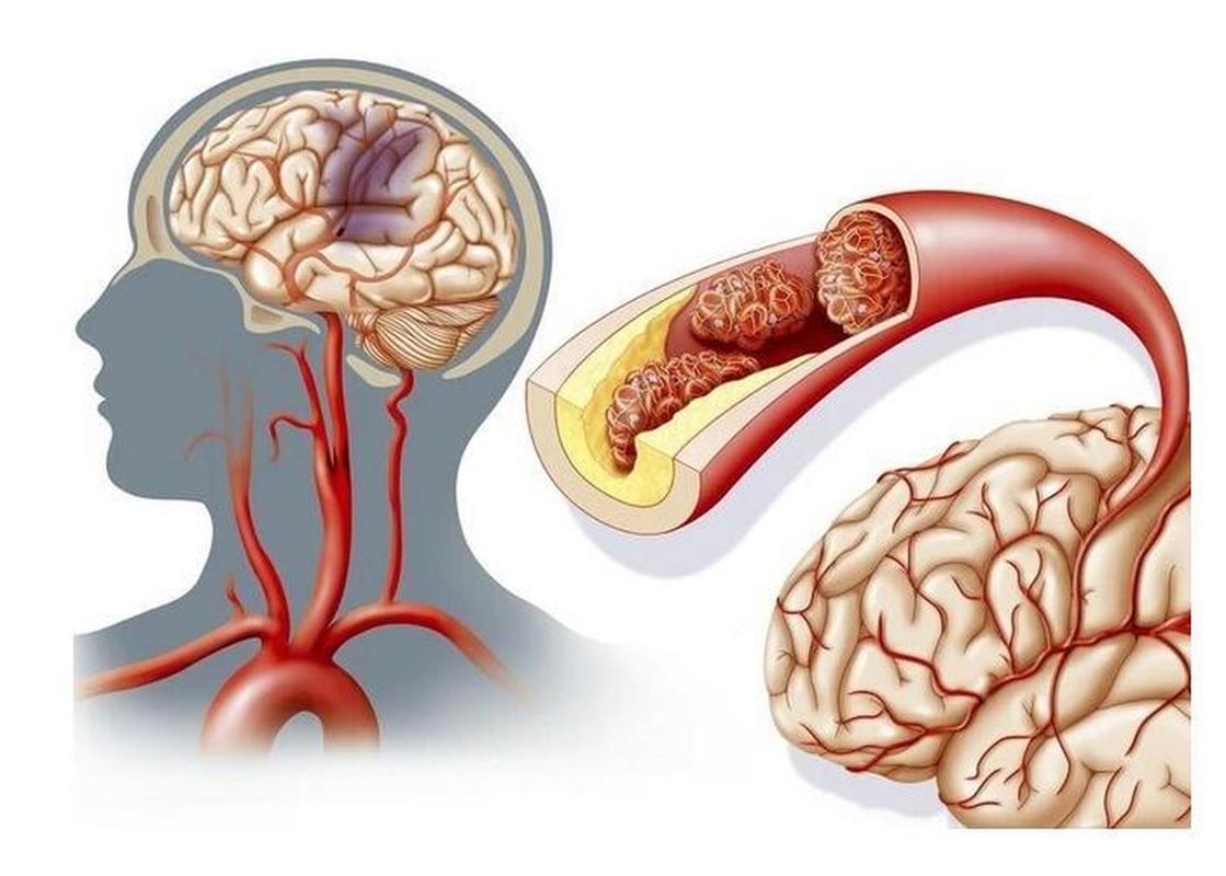 左侧脑突发大面积脑梗