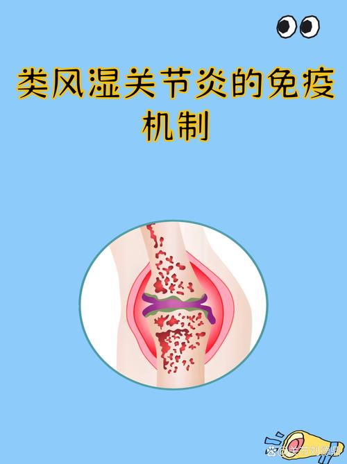 风湿因子20是类风湿