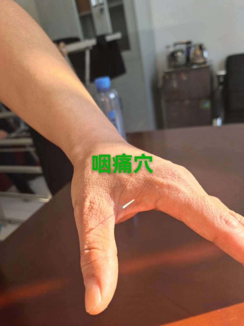 扁桃体发炎灸哪个穴位