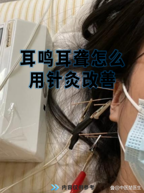 突发性耳聋的穴位治疗