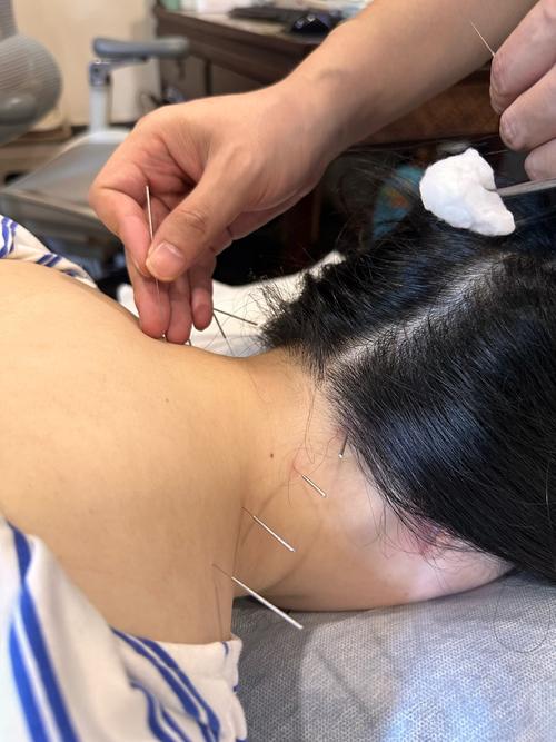 植物神经紊乱针灸穴位