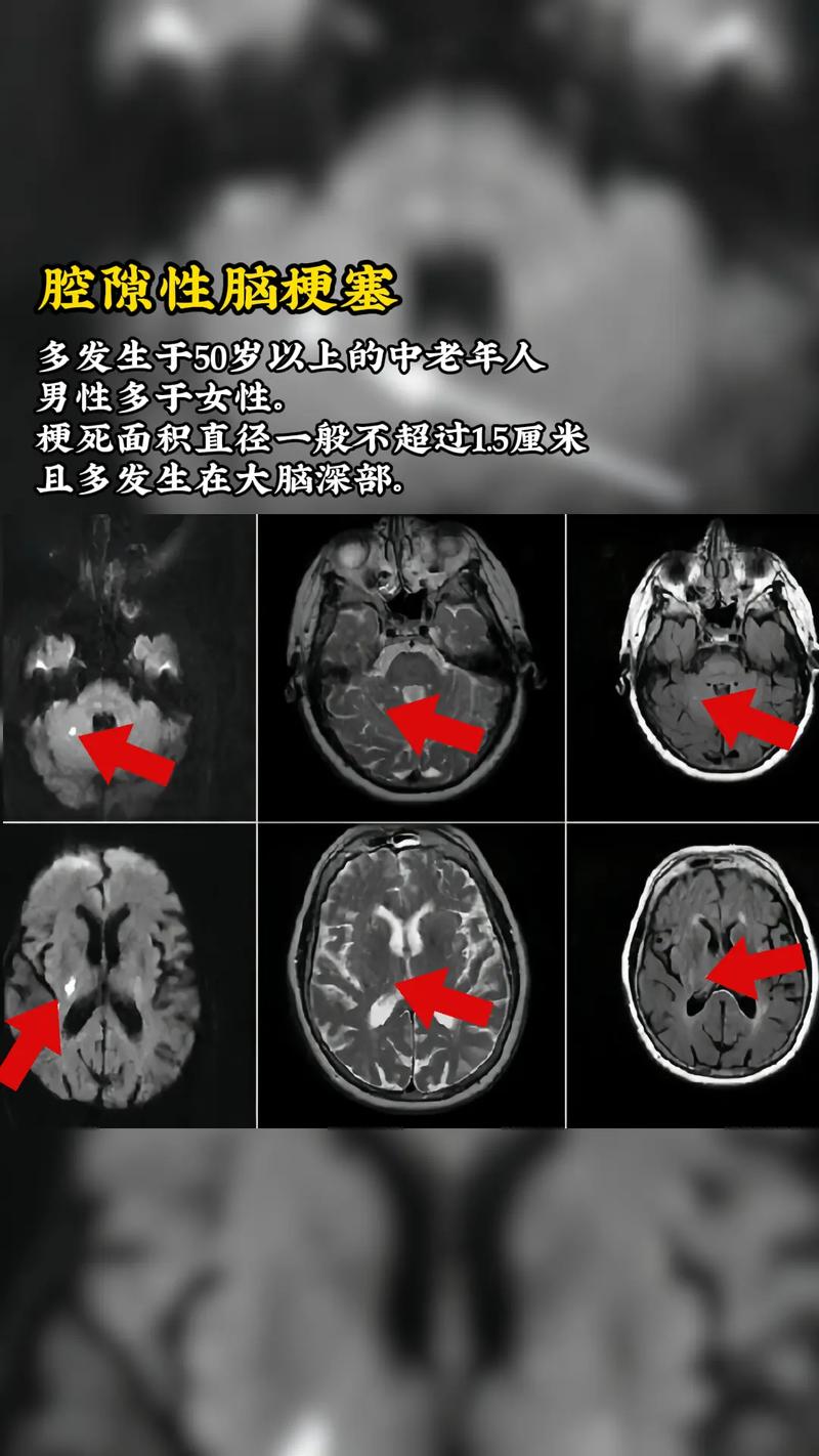 脑软化灶 多发性脑梗