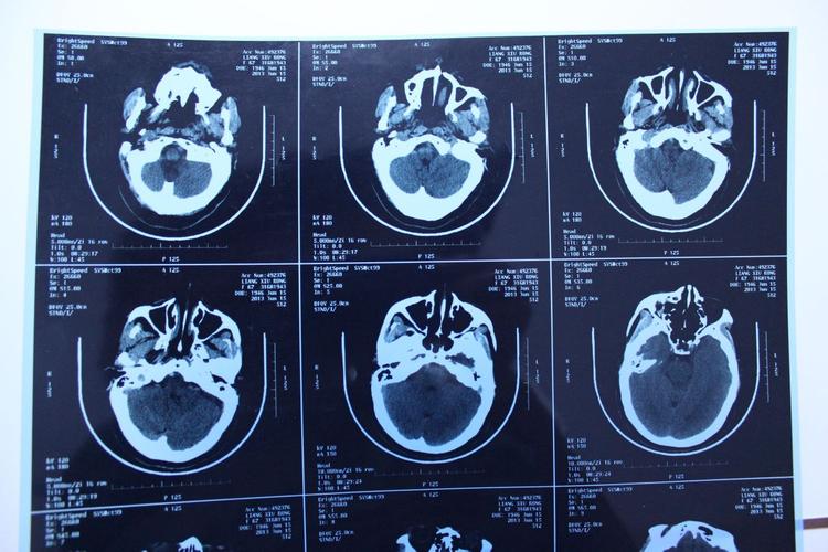 脑软化灶 多发性脑梗