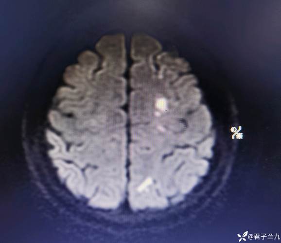 脑软化灶 多发性脑梗