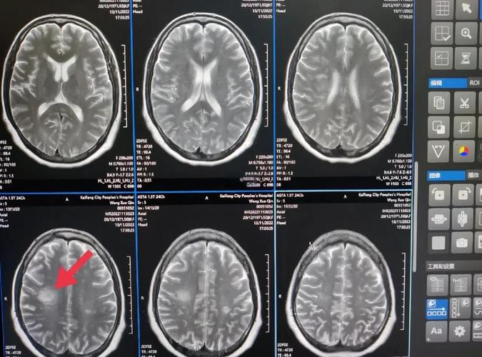 脑彩超可以看出脑梗吗