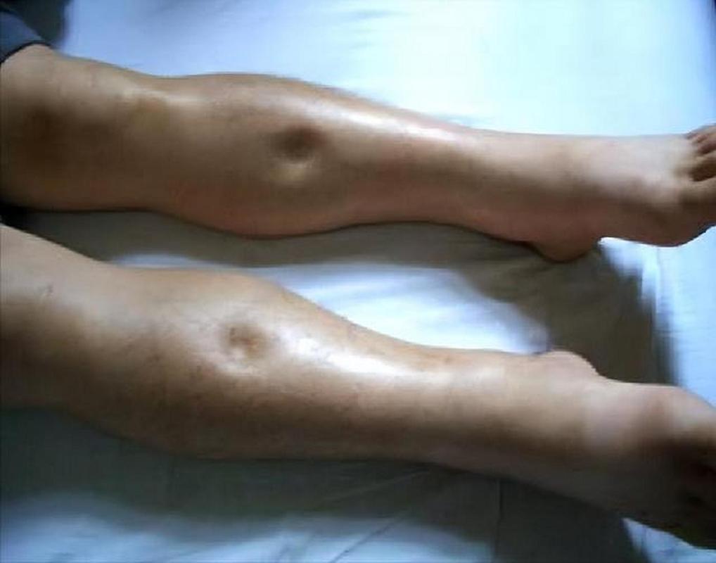 老人 脑梗 腹部水肿