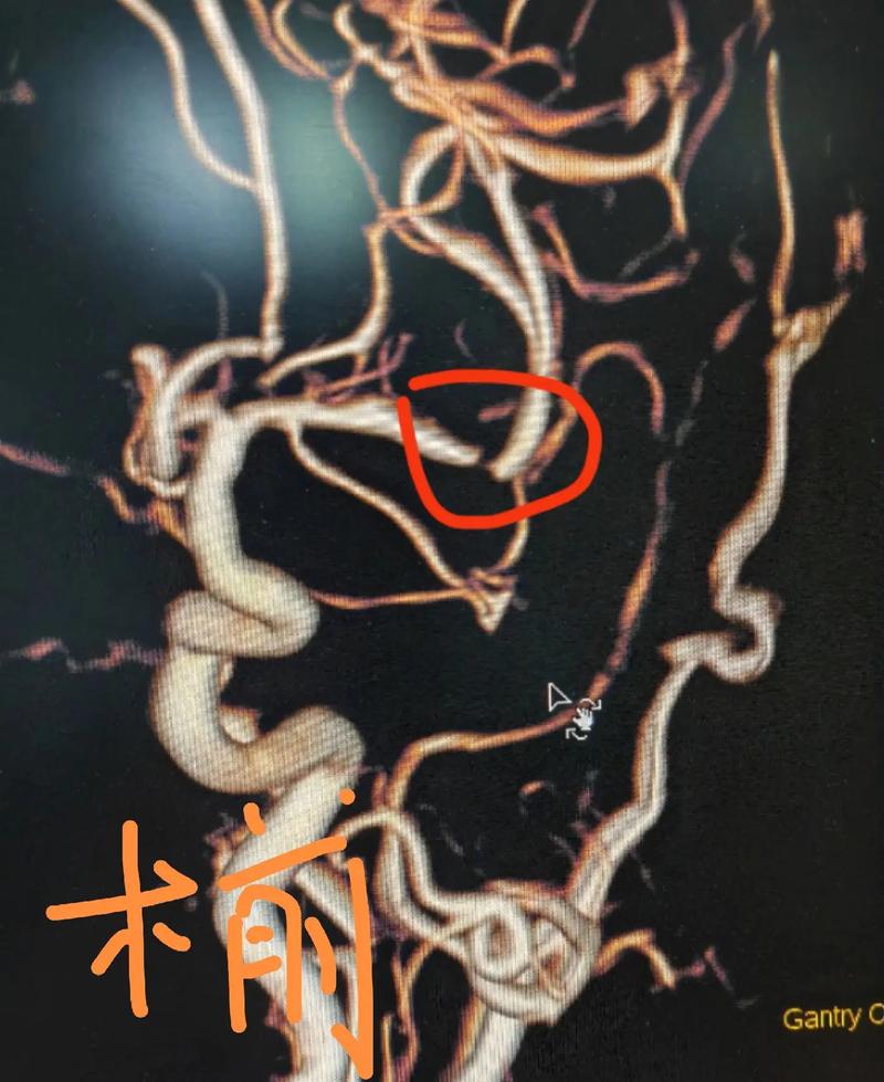 脑梗左脑右脑动脉堵压