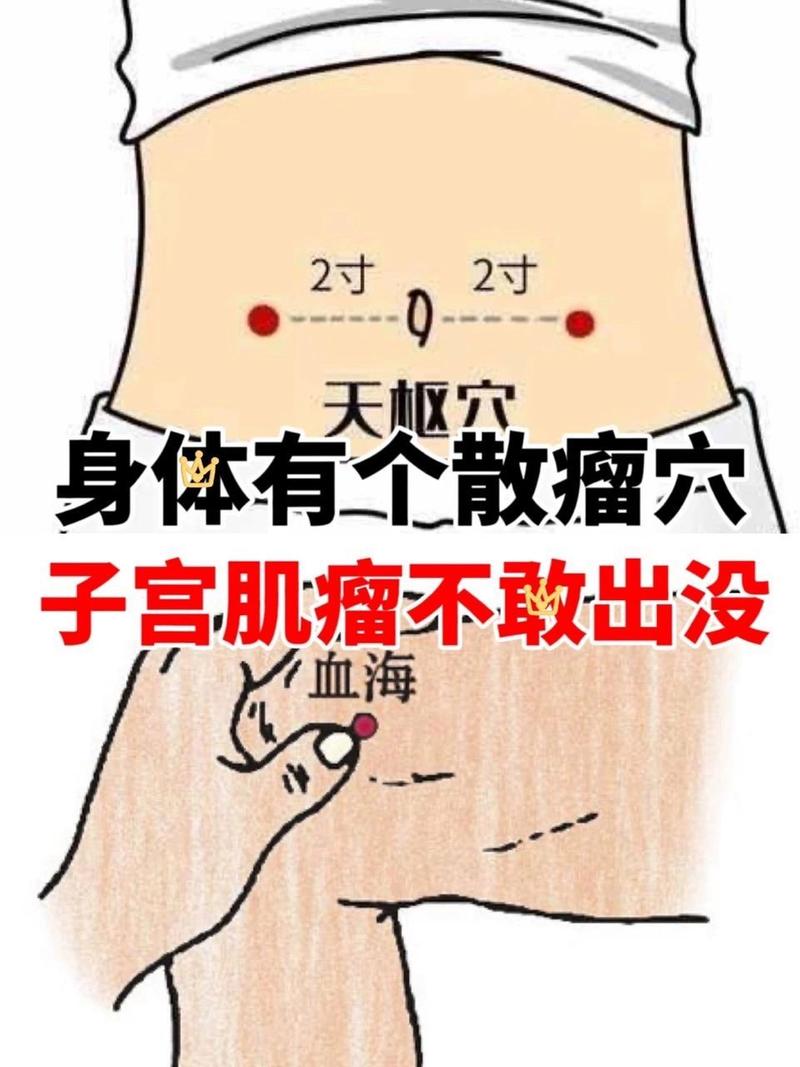 子宫肌瘤按摩哪些穴位