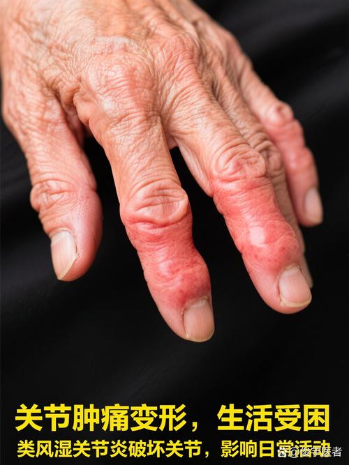 风湿类风湿引起的瘫痪