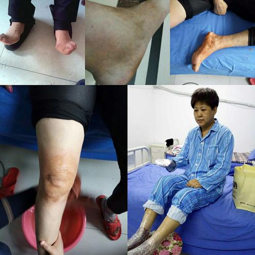 风湿类风湿引起的瘫痪