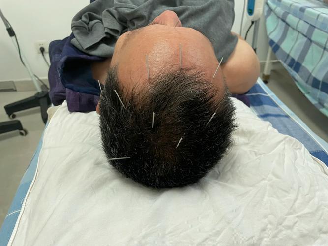 脑梗 总有口水 针灸