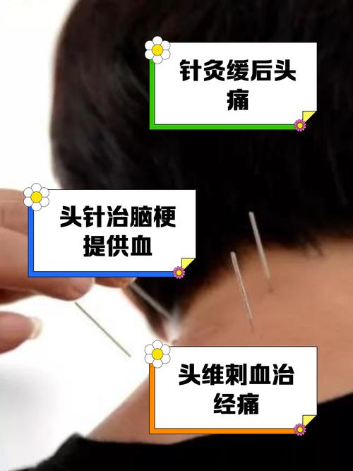 脑梗 总有口水 针灸