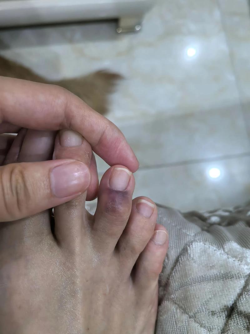 脑梗 卧床 脚趾 肿