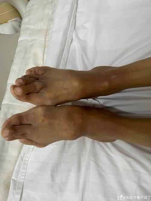 风湿 类风湿 关节炎