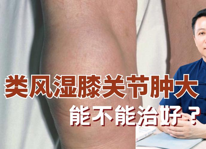 膝关节 风湿 类风湿