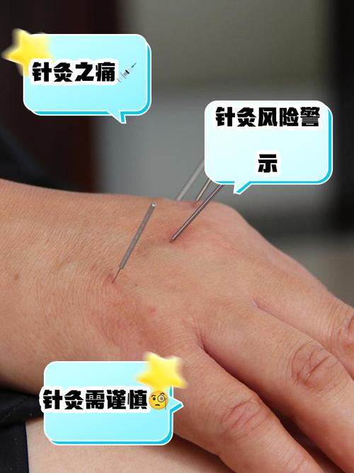 正中神经损伤针灸穴位