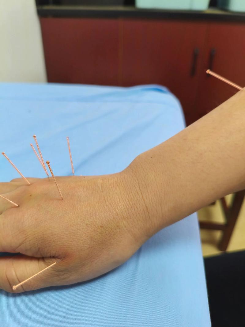 正中神经损伤针灸穴位