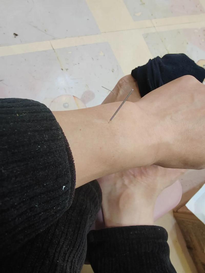 正中神经损伤针灸穴位