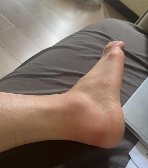 风湿类风湿 脚踝浮肿