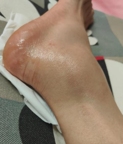 风湿类风湿 脚踝浮肿