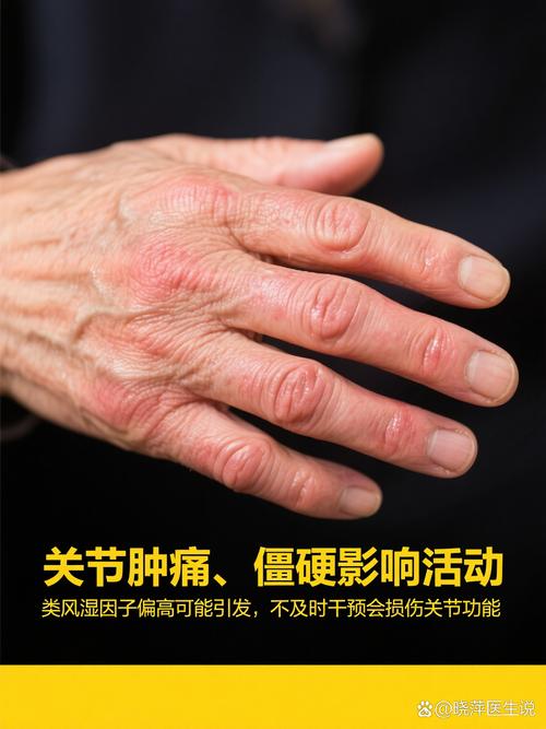 火神派 风湿 类风湿