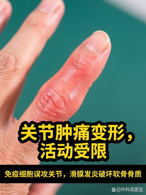 火神派 风湿 类风湿