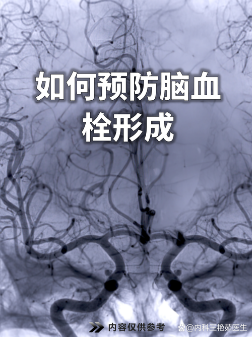 脑微血管堵塞是脑梗吗