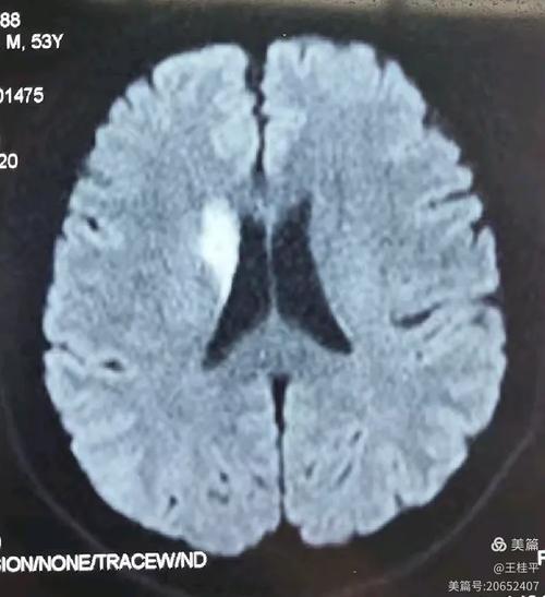 右侧脑动脉大面积脑梗