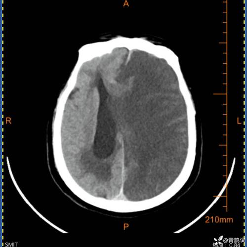 右侧脑动脉大面积脑梗
