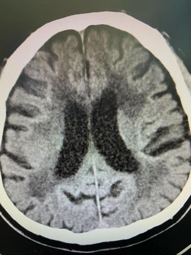 脑梗伴脑内多发微出血