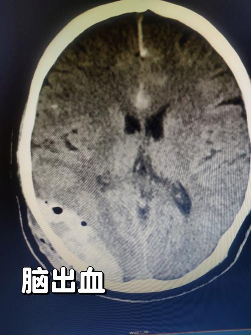 脑梗伴脑内多发微出血