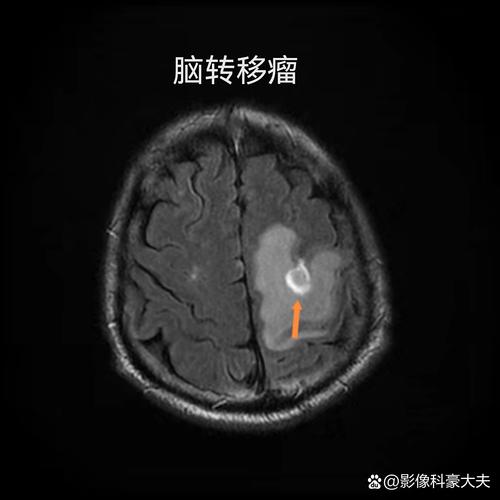 脑磁共振能查出脑梗吗