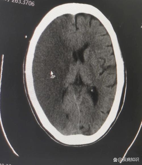 脑核磁有斑块轻微脑梗
