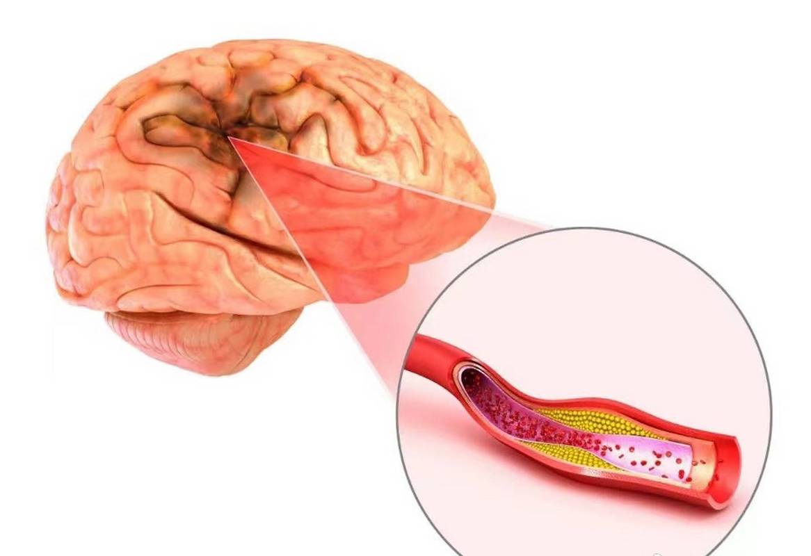 脑内散在缺血灶 脑梗