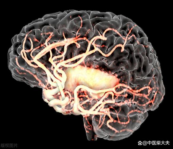脑内散在缺血灶 脑梗