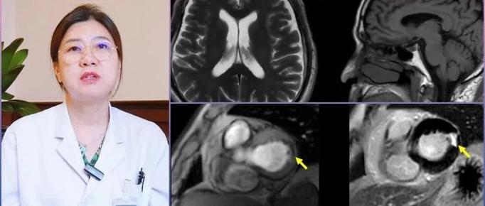 脑梗可以不做脑共磁吗