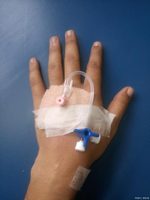 风湿 类风湿输液治疗