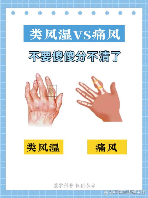 风湿病分风湿和类风湿